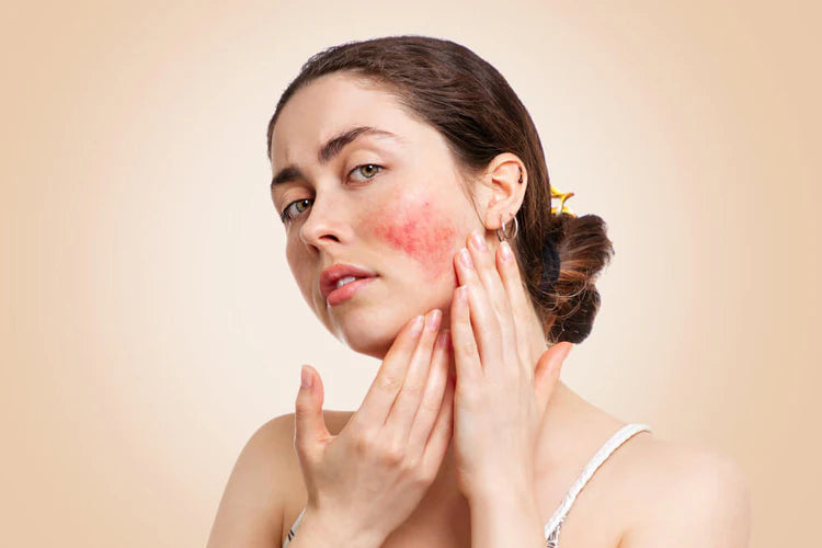 Rosacea: All The Information You Need