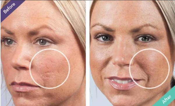 Home Remedies for Acne Scars - What Realy Works?