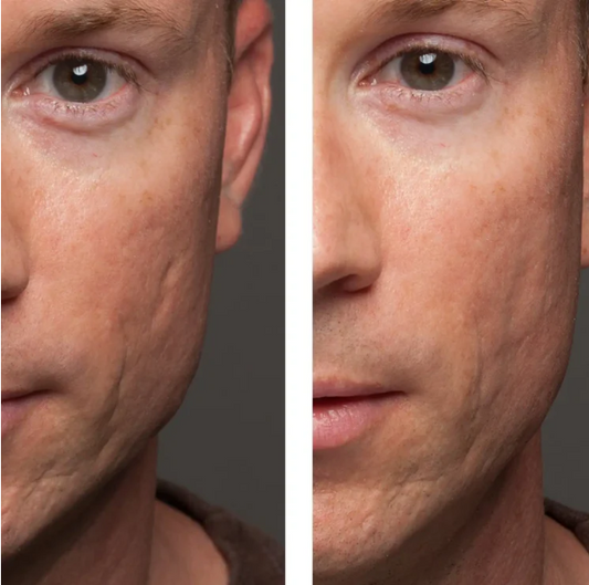 How to Get Rid of Acne Scars
