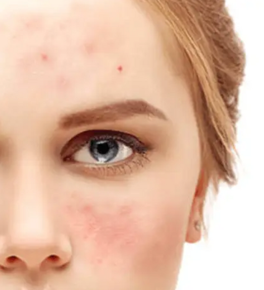Skin Redness Makeup