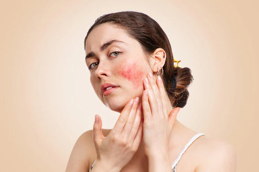 Rosacea: All The Information You Need